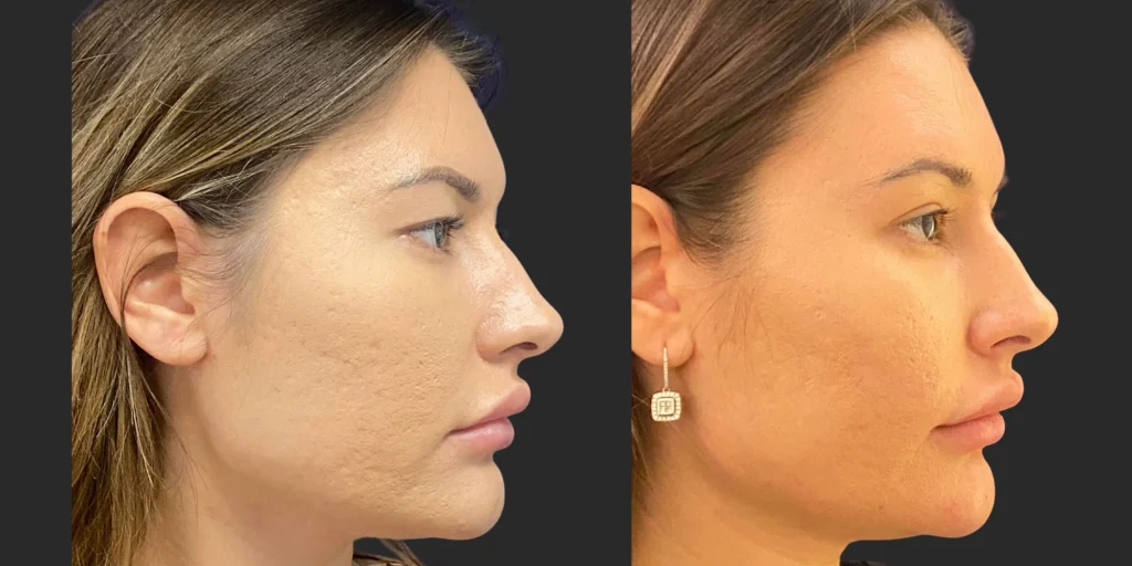 Upper Blepharoplasty #001, before and after photo, view 2