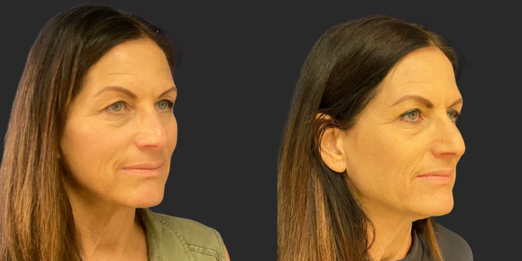 Upper Blepharoplasty #002, before and after photo, view 2