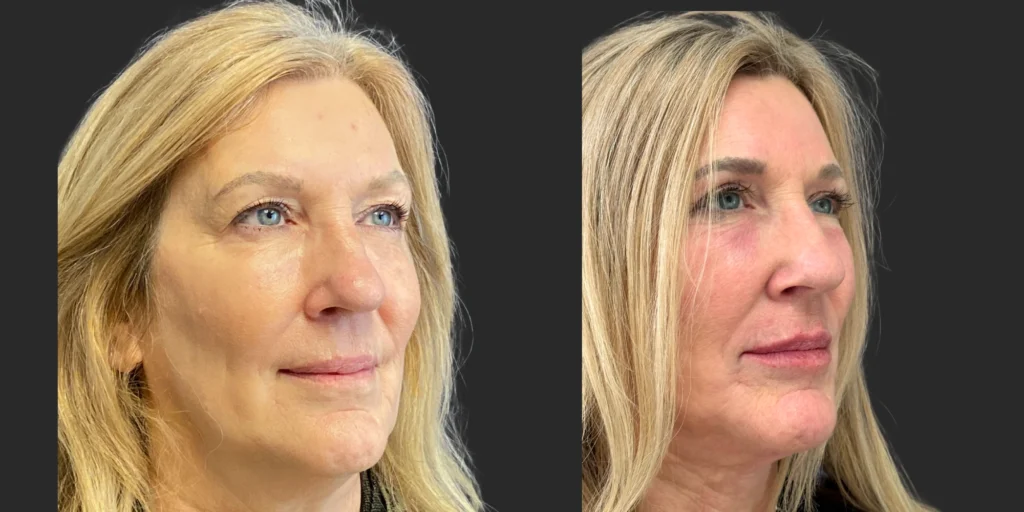 Cameo 2 and Rhinoplasty and Upper Blepharoplasty and Lip Fillers #003, before and after photo, view 2