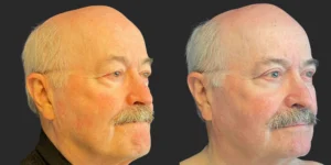 Upper Blepharoplasty #004, before and after photo, view 2