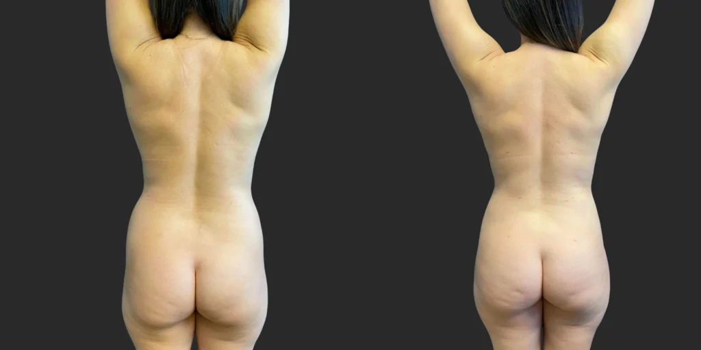 360 Lipo #040, before and after photo, view 3