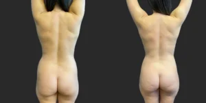 360 Lipo #040, before and after photo, view 3