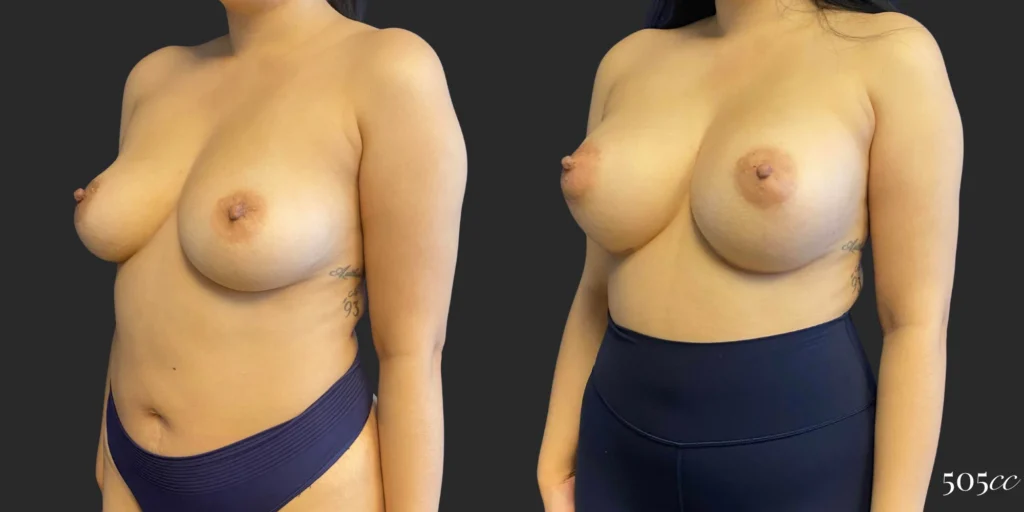 Breast Augmentation #106, before and after photo, view 2