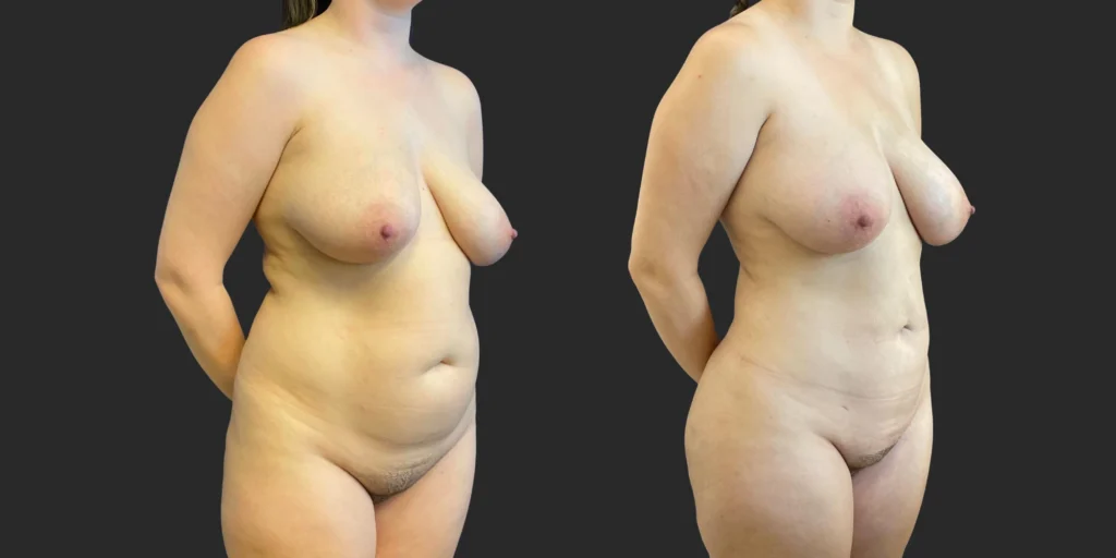 360 Lipo with Fat Transfer to Buttocks + Breasts #041, before and after photo, view 2