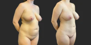 360 Lipo with Fat Transfer to Buttocks + Breasts #041, before and after photo, view 2