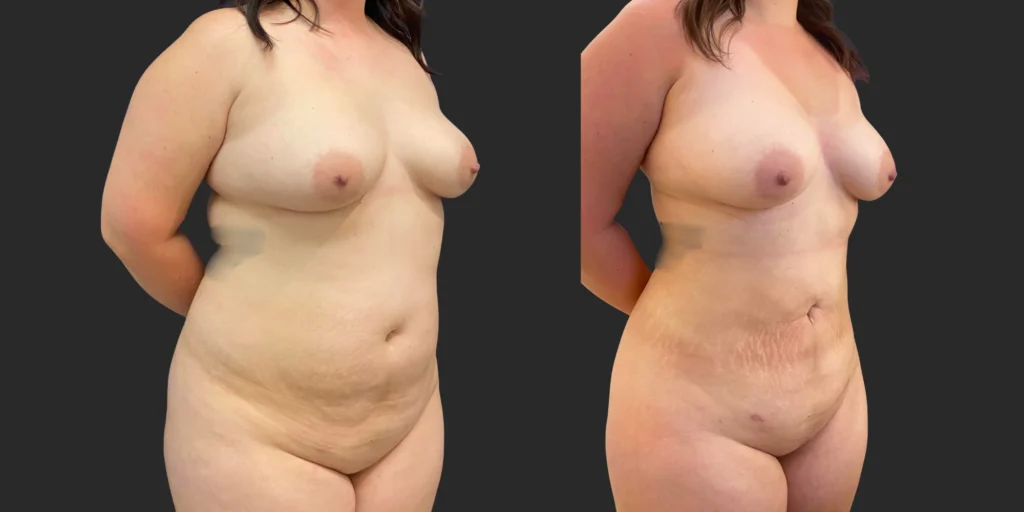 360 Lipo #042, before and after photo, view 2