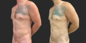 360 Lipo + Chest + Front Brall Roll with Fat Transfer to Buttocks #043, before and after photo, view 2