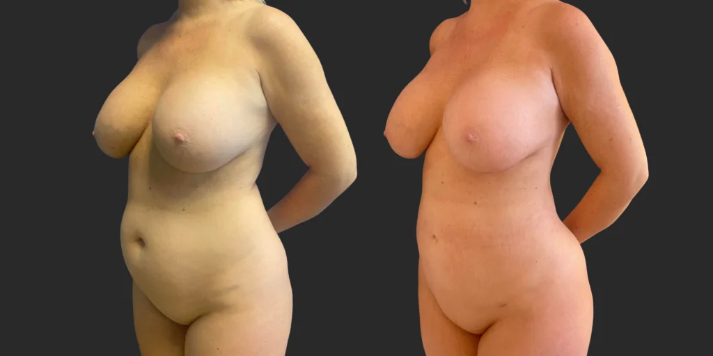 360 Lipo #044, before and after photo, view 2