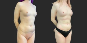 360 Lipo with Fat Transfer to Buttocks + Breasts #045, before and after photo, view 2