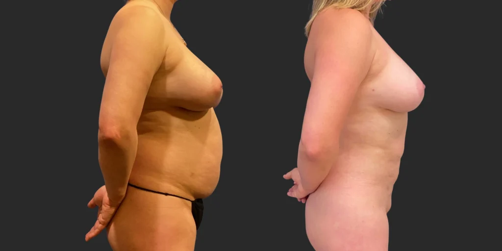 360 Lipo +Pubis #046, before and after photo, view 2