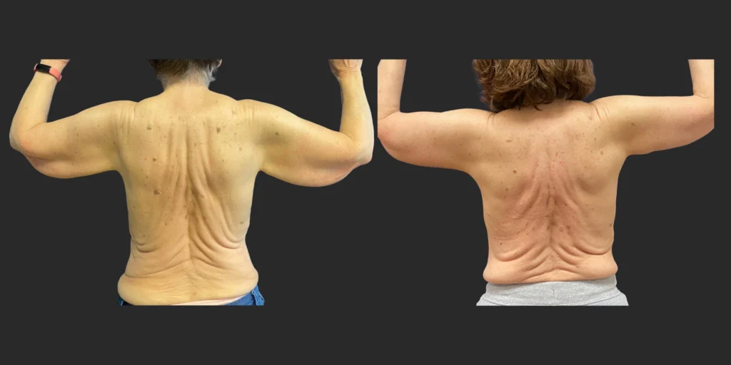 Arm Lift (Brachioplasty) #004, before and after photo, view 2