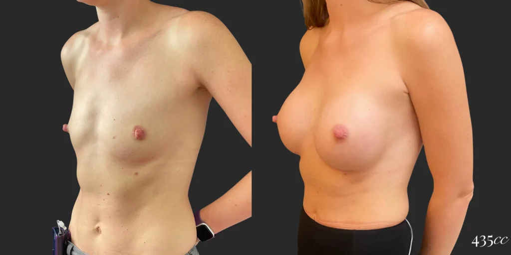 Breast Augmentation #101, before and after photo, view 2
