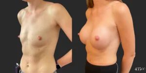 Breast Augmentation #101, before and after photo, view 2