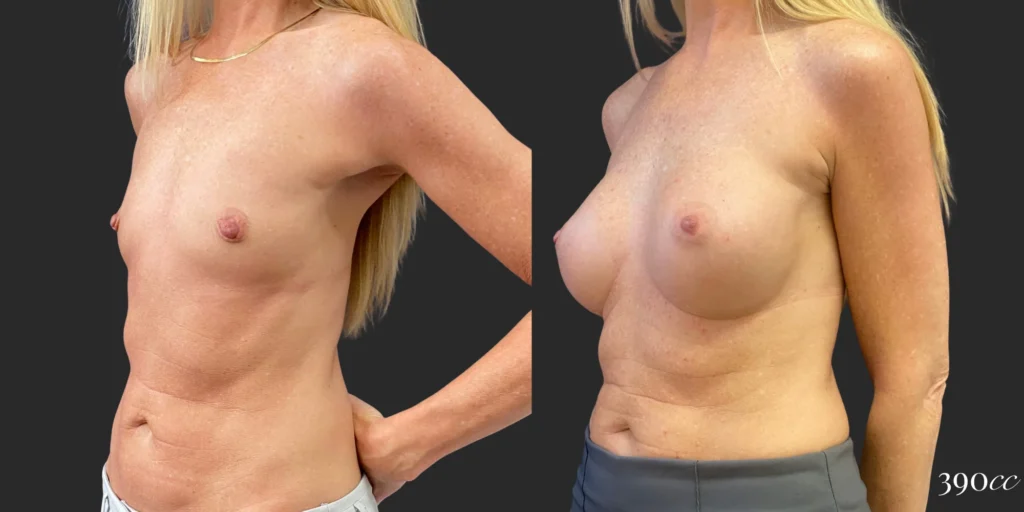 Breast Augmentation #102, before and after photo, view 2