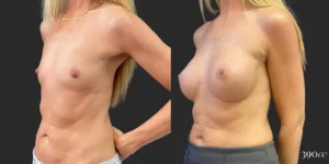 Breast Augmentation #102, before and after photo, view 2