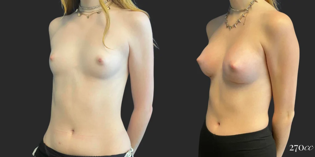 Breast Augmentation #107, before and after photo, view 2