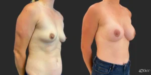 Breast Augmentation #108, before and after photo, view 2