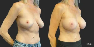 Breast Augmentation #110, before and after photo, view 2