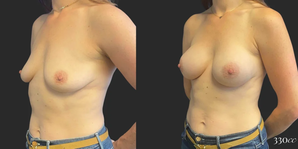 Breast Augmentation #111, before and after photo, view 2