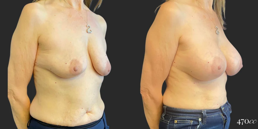 Breast Augmentation #112, before and after photo, view 2