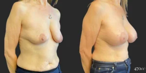Breast Augmentation #112, before and after photo, view 2