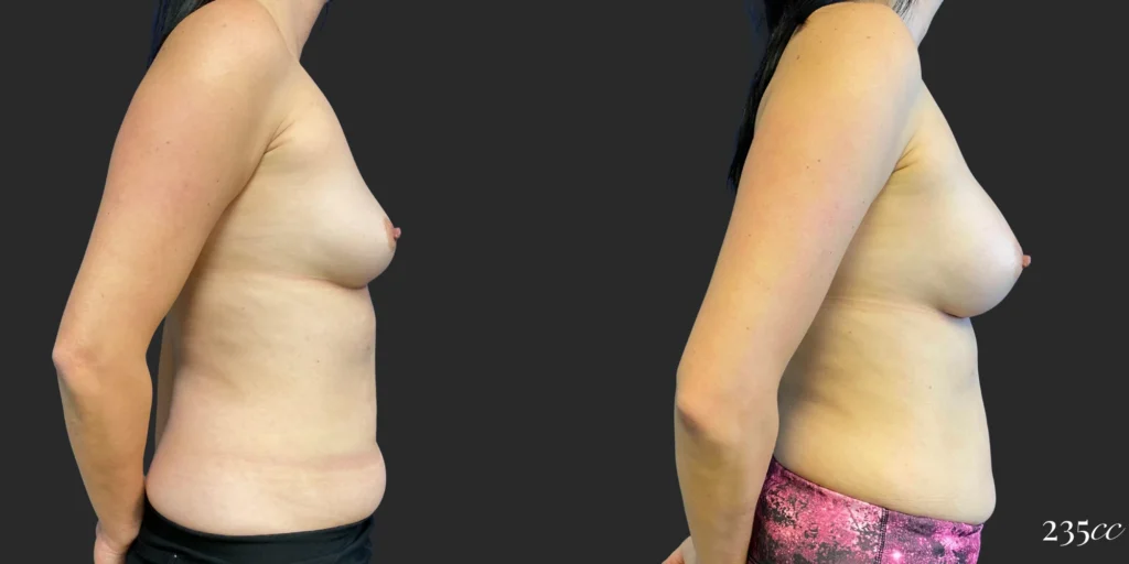 Breast Augmentation #114, before and after photo, view 3