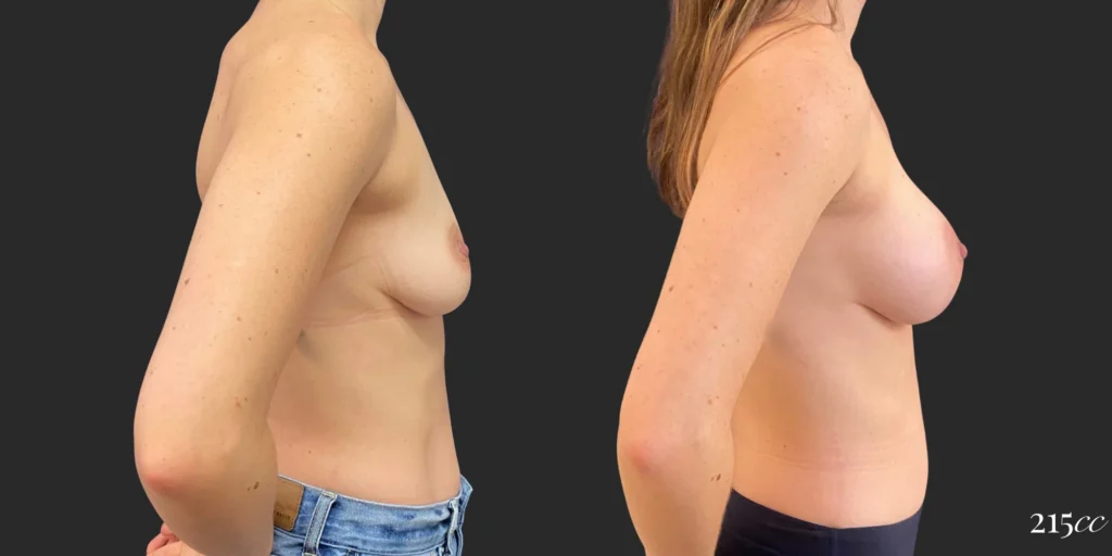 Breast Augmentation #103, before and after photo, view 3