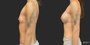 Breast Augmentation #116, before and after photo, view 3