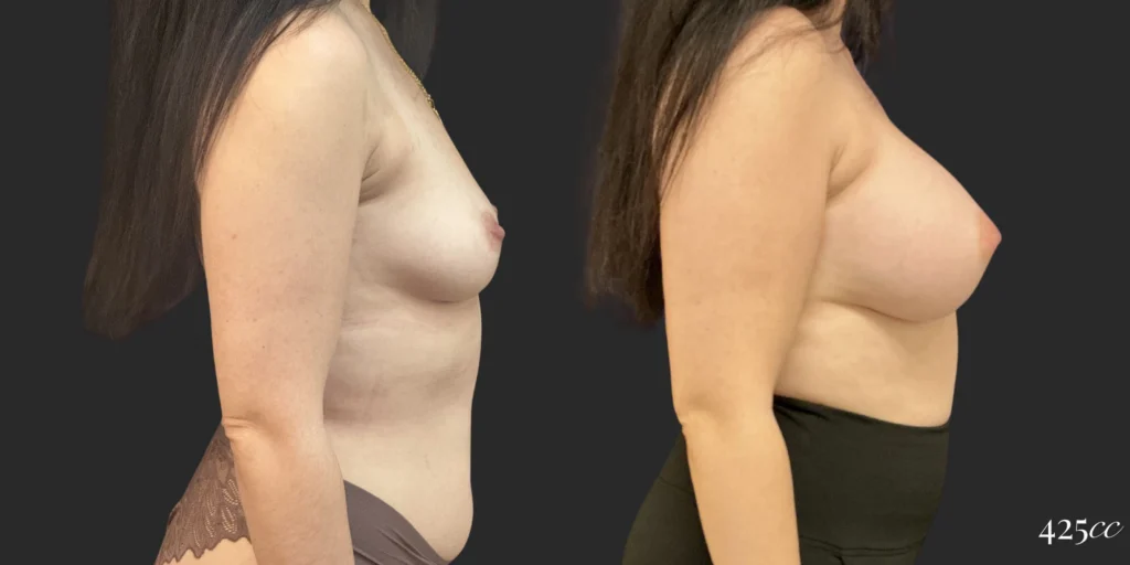Breast Augmentation #117, before and after photo, view 3