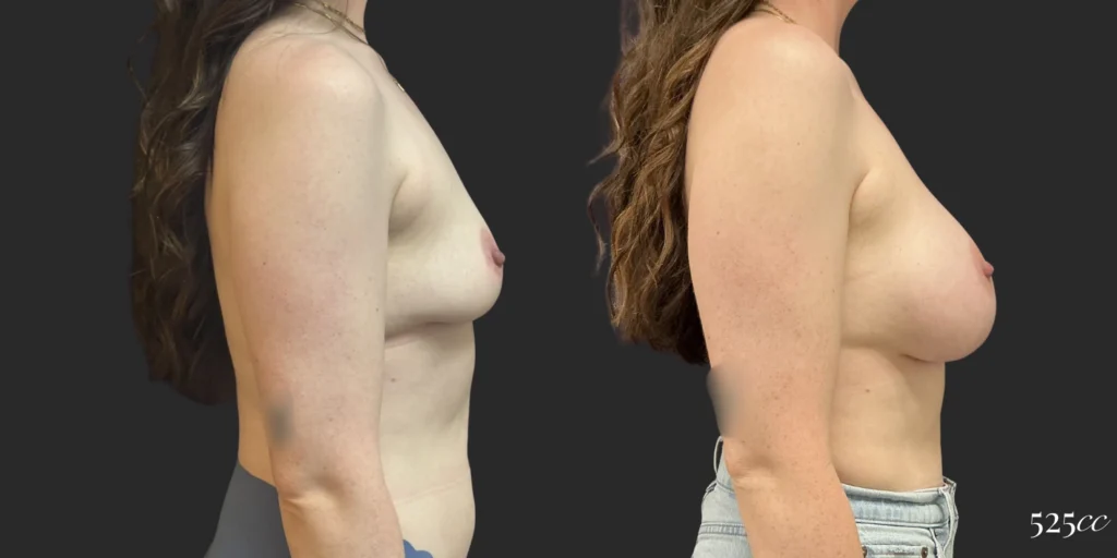 Breast Augmentation #119, before and after photo, view 3