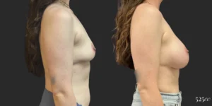 Breast Augmentation #119, before and after photo, view 3
