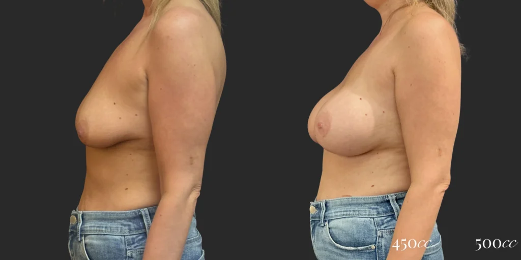 Breast Augmentation #120, before and after photo, view 3