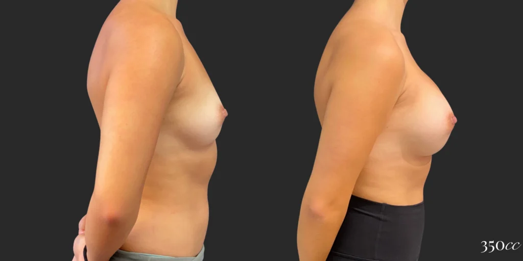 Breast Augmentation #122, before and after photo, view 3