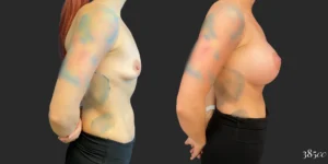 Breast Augmentation #124, before and after photo, view 3