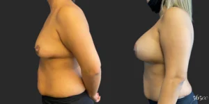 Breast Augmentation #105, before and after photo, view 3
