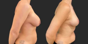 Breast Implant Removal #020, before and after photo, view 3