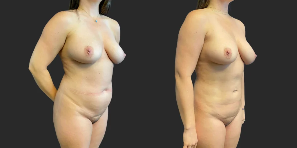 360 Lipo #040, before and after photo, view 2