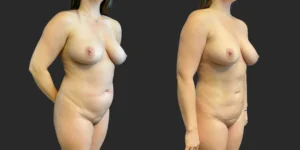 360 Lipo #040, before and after photo, view 2