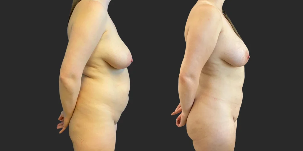 360 Lipo with Fat Transfer to Buttocks + Breasts #041, before and after photo, view 3
