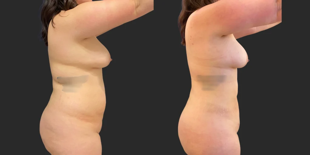 360 Lipo #042, before and after photo, view 3