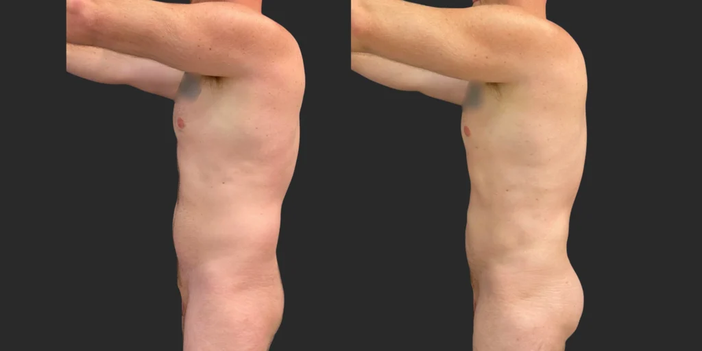 360 Lipo + Chest + Front Brall Roll with Fat Transfer to Buttocks #043, before and after photo, view 3