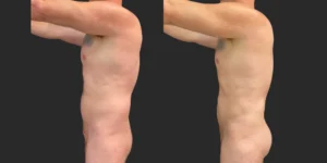 360 Lipo + Chest + Front Brall Roll with Fat Transfer to Buttocks #043, before and after photo, view 3