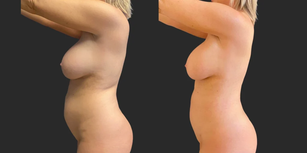 360 Lipo #044, before and after photo, view 3