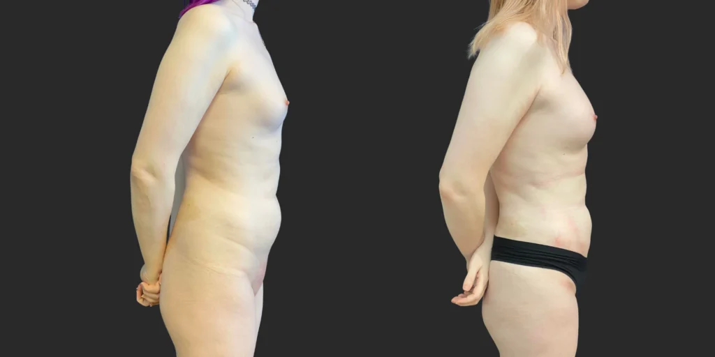 360 Lipo with Fat Transfer to Buttocks + Breasts #045, before and after photo, view 3