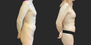 360 Lipo with Fat Transfer to Buttocks + Breasts #045, before and after photo, view 3