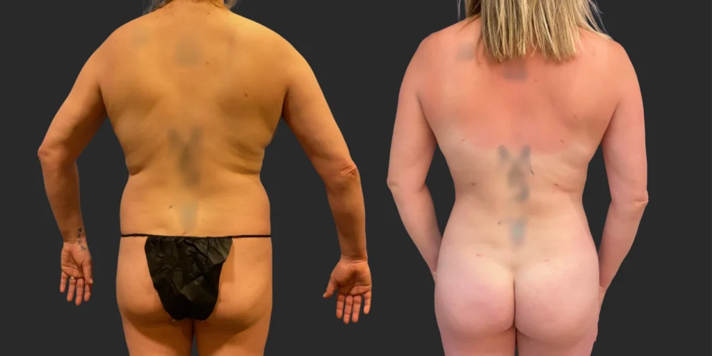 360 Lipo +Pubis #046, before and after photo, view 3