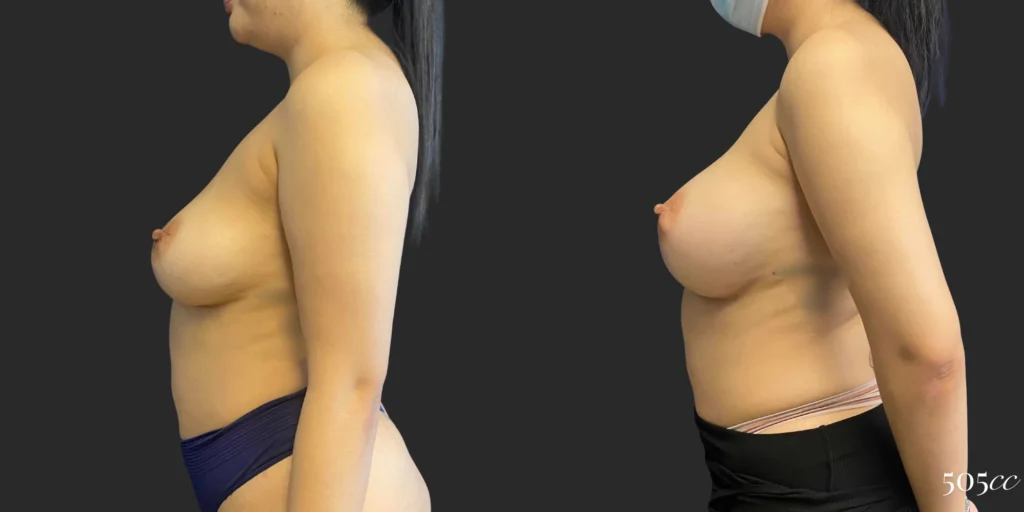 Breast Augmentation #106, before and after photo, view 3