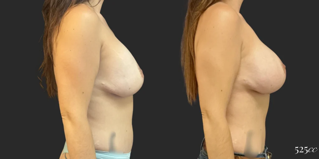 On Top® Pocket Change #12, before and after photo, view 3