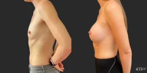 Breast Augmentation #101, before and after photo, view 3