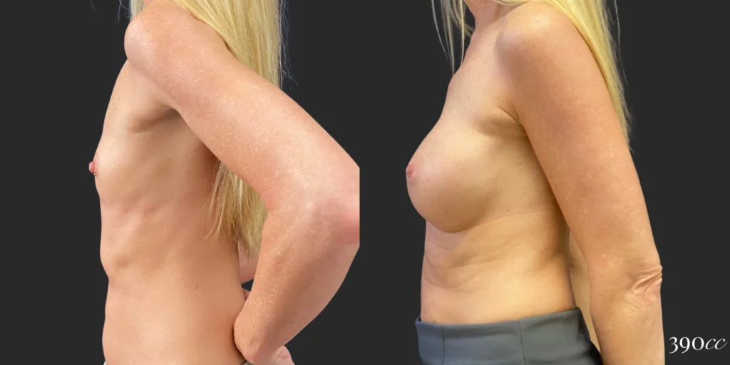 Breast Augmentation #102, before and after photo, view 3